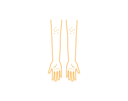 アトピー性皮膚炎