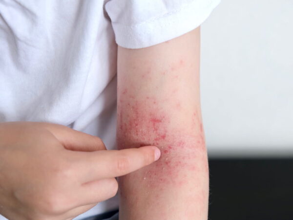 アトピー性皮膚炎の症状