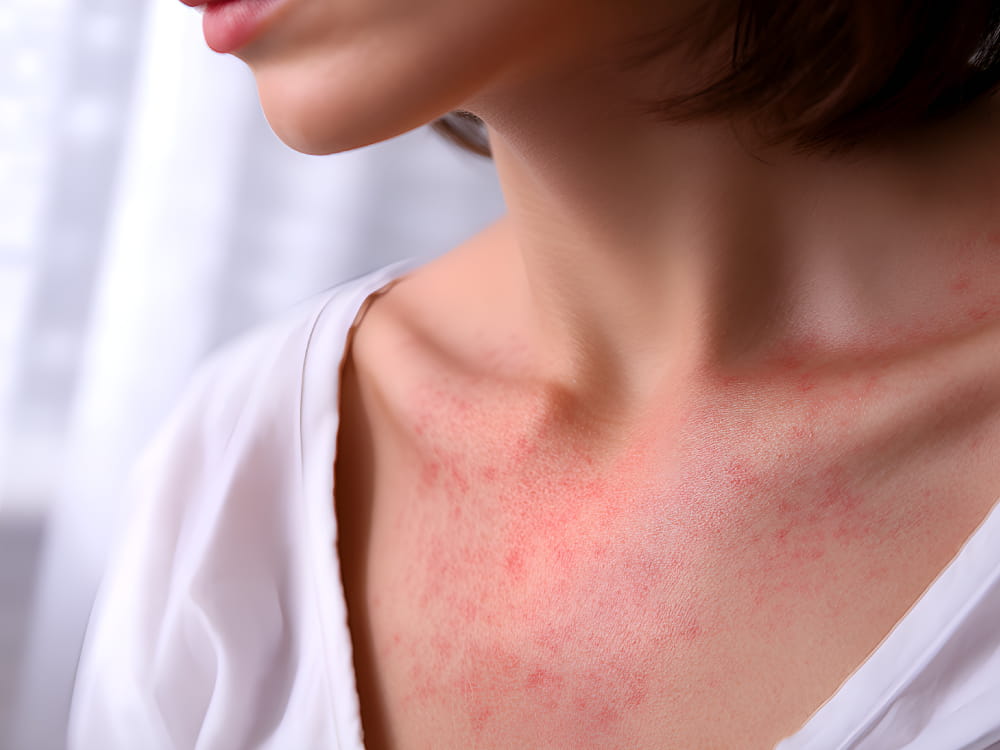 蕁麻疹(じんましん)