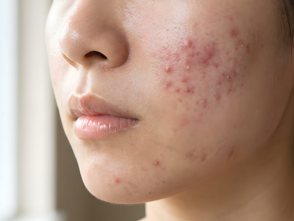 ニキビ治療